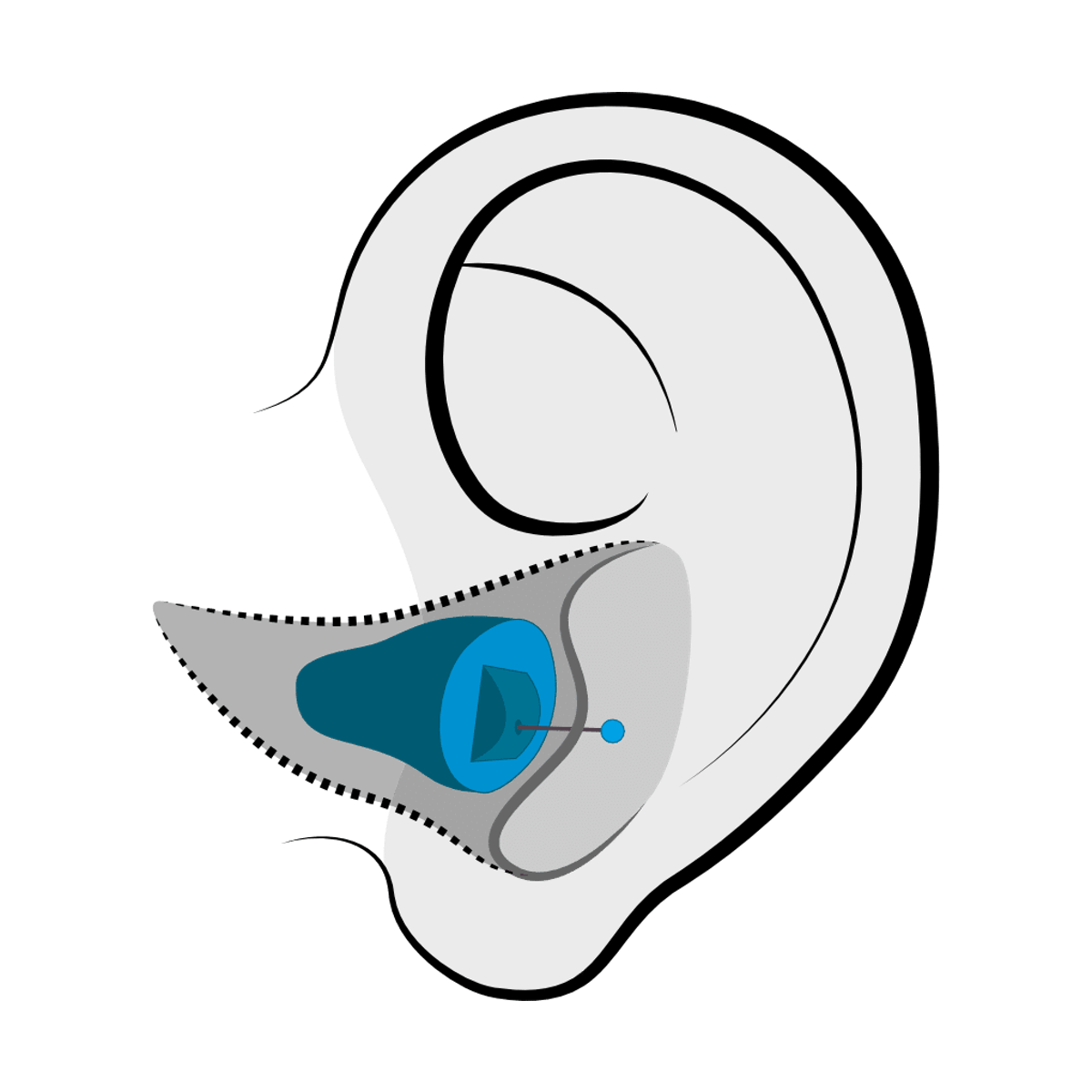 Invisible-in-Canal (IIC) hearing aid style available at Physicians Hearing Clinic in Sarasota, FL
